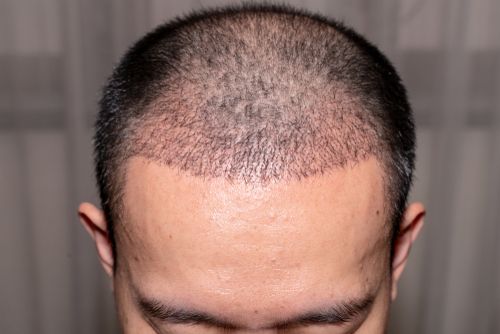 What To Expect After A Hair Implant Procedure?