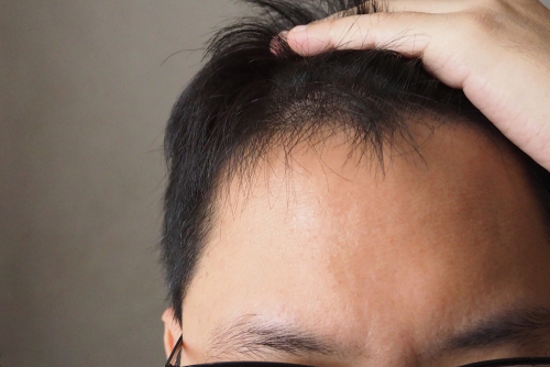 What To Expect After A Hair Implant Procedure?