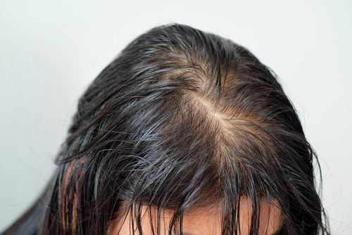 Oily Scalp: Causes, Prevention, and Solution 