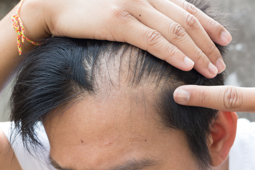 Male hair loss pattern