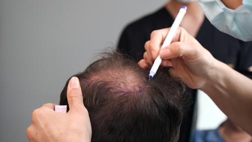 When Is the Right Age to Consider Hair Implants