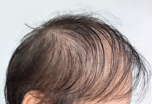 Types of Hair Loss, Causes, and Solutions