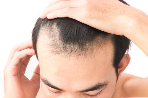 Hair Implants for Frontal Baldness