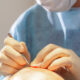 How Lifestyle Factors Affect Hair Implant Success
