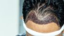 Minimizing Scarring After Hair Transplant Surgery - Hair Implant Singapore