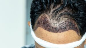 Minimizing Scarring After Hair Transplant Surgery - Hair Implant Singapore
