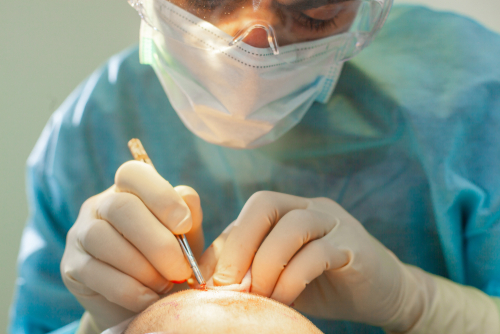 Mechanisms Behind Hair Transplant Regrowth